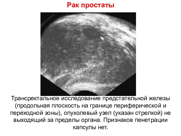 Рак простаты Трансректальное исследование предстательной железы (продольная плоскость на границе периферической и переходной
