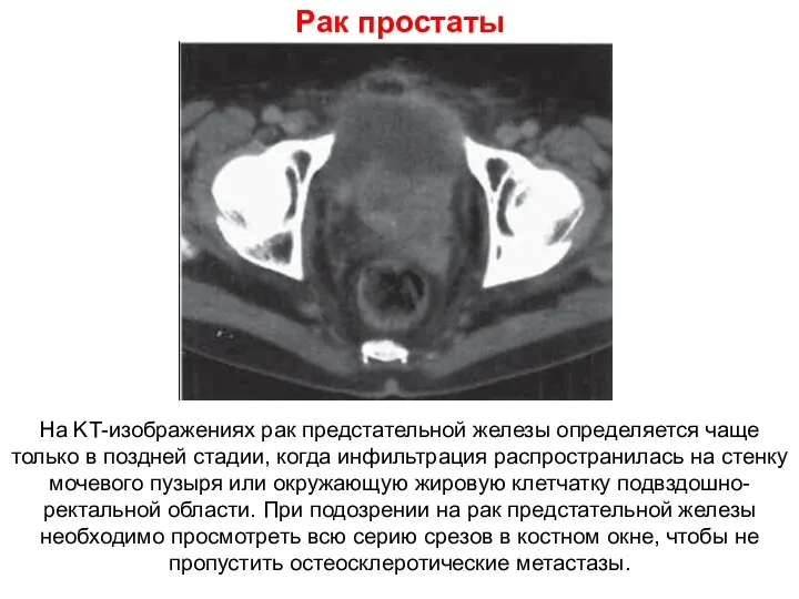 Рак простаты На KT-изображениях рак предстательной железы определяется чаще только