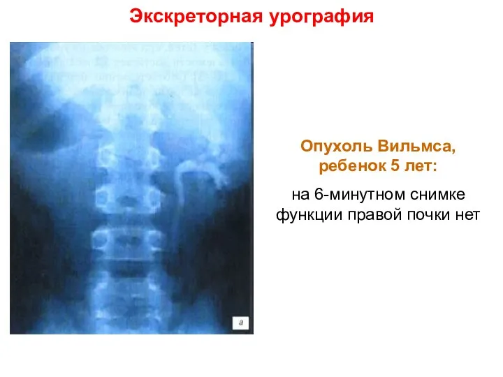 Экскреторная урография Опухоль Вильмса, ребенок 5 лет: на 6-минутном снимке функции правой почки нет