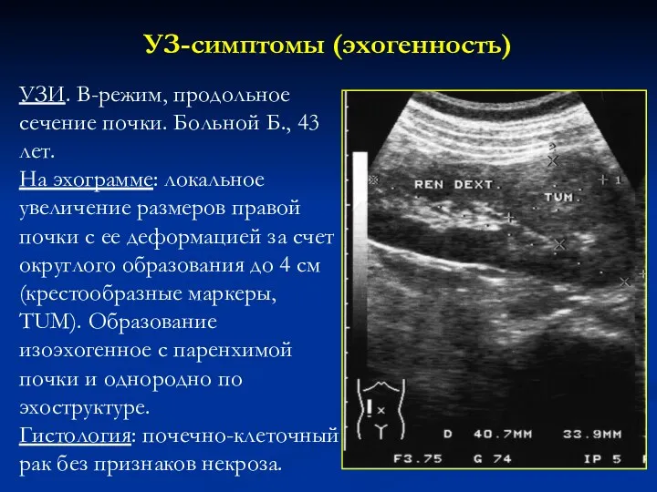 УЗ-симптомы (эхогенность) УЗИ. В-режим, продольное сечение почки. Больной Б., 43