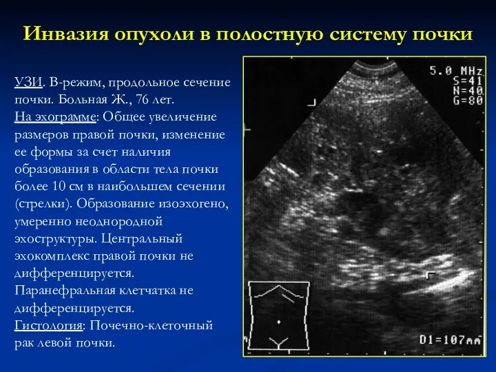 Инвазия опухоли в полостную систему почки УЗИ. В-режим, продольное сечение