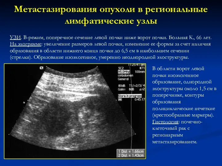 Метастазирования опухоли в региональные лимфатические узлы УЗИ. В-режим, поперечное сечение