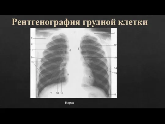 Рентгенография грудной клетки Норма