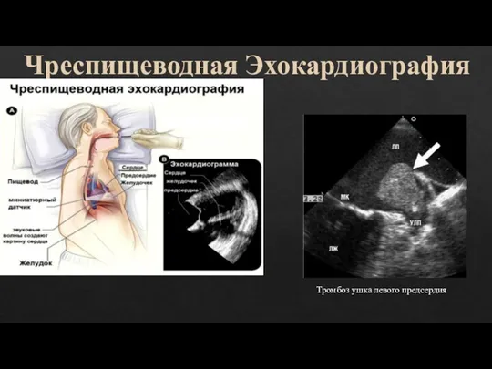 Чреспищеводная Эхокардиография Тромбоз ушка левого предсердия