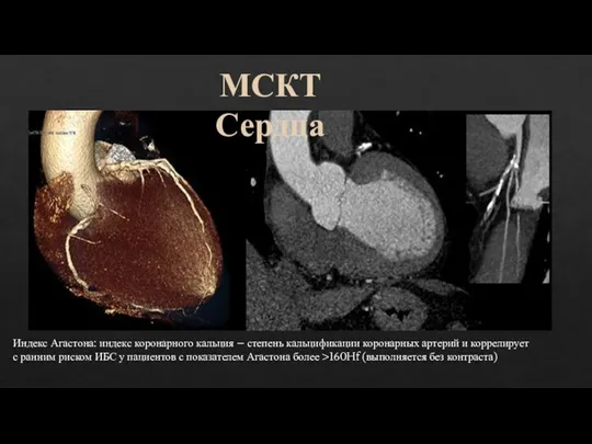 МСКТ Сердца Индекс Агастона: индекс коронарного кальция – степень кальцификации