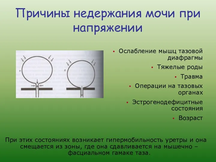 Причины недержания мочи при напряжении Ослабление мышц тазовой диафрагмы Тяжелые