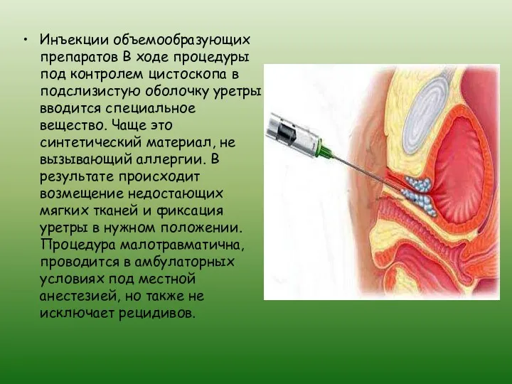 Инъекции объемообразующих препаратов В ходе процедуры под контролем цистоскопа в