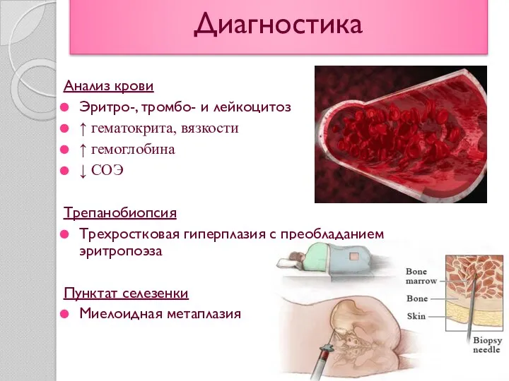 Диагностика Анализ крови Эритро-, тромбо- и лейкоцитоз ↑ гематокрита, вязкости