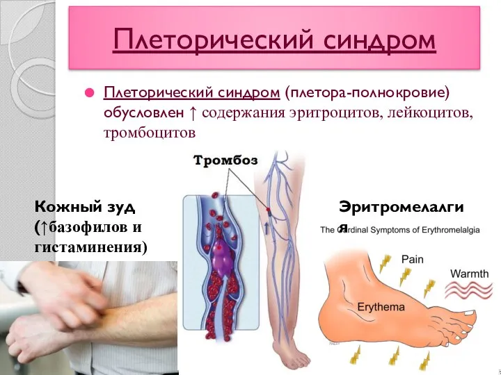 Плеторический синдром Плеторический синдром (плетора-полнокровие) обусловлен ↑ содержания эритроцитов, лейкоцитов,