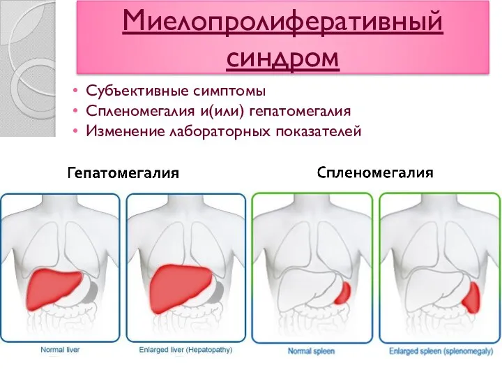 Миелопролиферативный синдром Субъективные симптомы Спленомегалия и(или) гепатомегалия Изменение лабораторных показателей