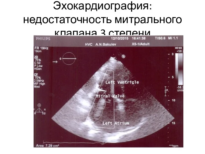 Эхокардиография: недостаточность митрального клапана 3 степени