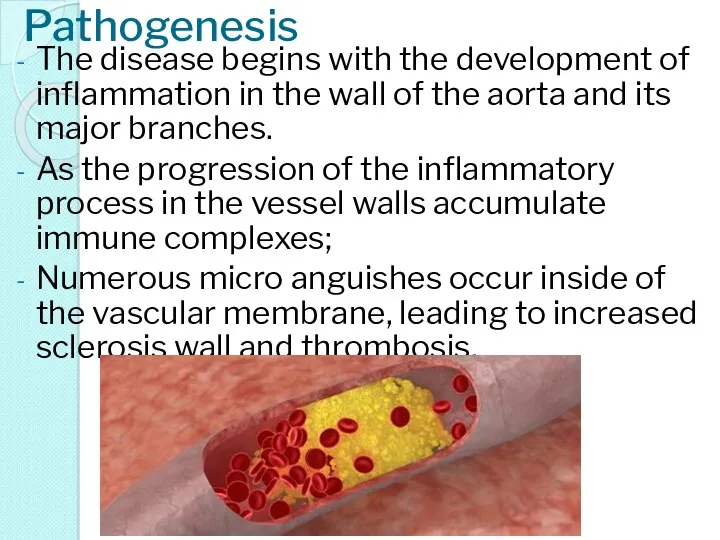 Pathogenesis The disease begins with the development of inflammation in