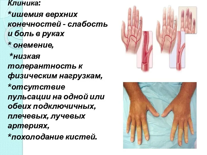 Клиника: *ишемия верхних конечностей - слабость и боль в руках