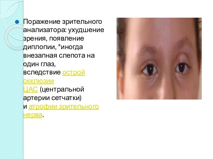 Поражение зрительного анализатора: ухудшение зрения, появление диплопии, *иногда внезапная слепота
