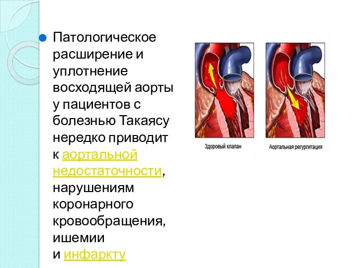 Патологическое расширение и уплотнение восходящей аорты у пациентов с болезнью