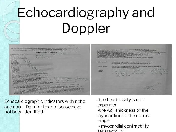 Еchocardiography and Doppler -the heart cavity is not expanded -the