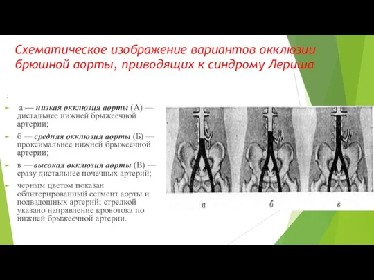 Схематическое изображение вариантов окклюзии брюшной аорты, приводящих к синдрому Лериша : а —