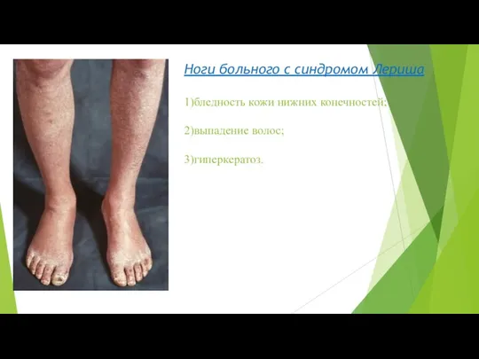 Ноги больного с синдромом Лериша 1)бледность кожи нижних конечностей; 2)выпадение волос; 3)гиперкератоз.