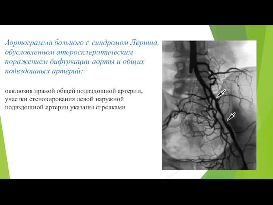Аортограмма больного с синдромом Лериша, обусловленном атеросклеротическим поражением бифуркации аорты и общих подвздошных