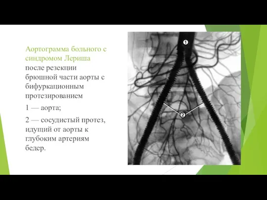 Аортограмма больного с синдромом Лериша после резекции брюшной части аорты