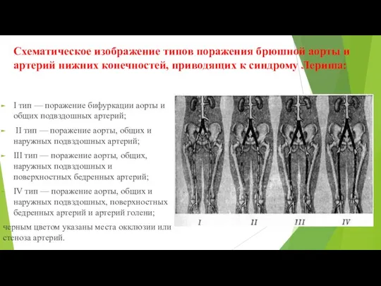 Схематическое изображение типов поражения брюшной аорты и артерий нижних конечностей,