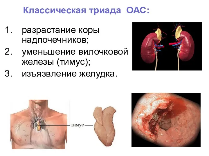 разрастание коры надпочечников; уменьшение вилочковой железы (тимус); изъязвление желудка. Классическая триада ОАС: