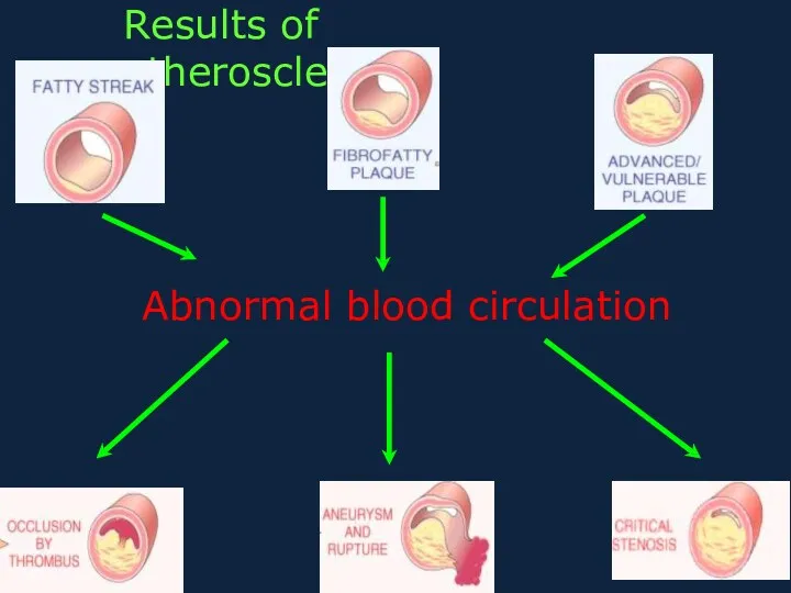 Results of atherosclerosis Abnormal blood circulation