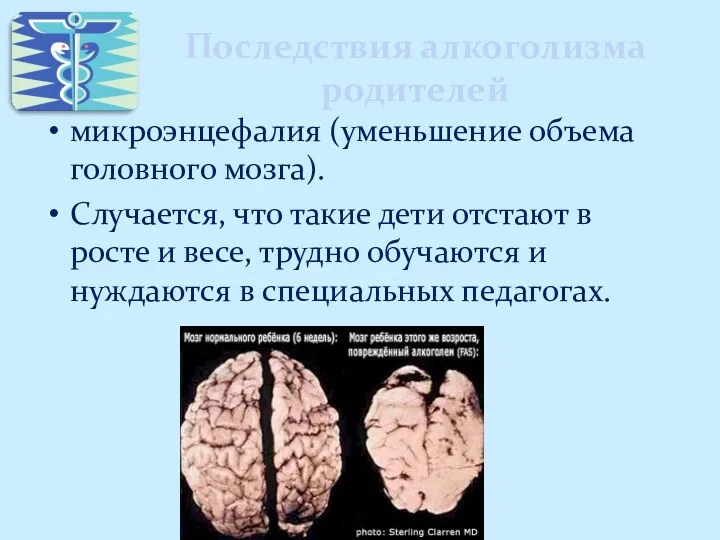 Последствия алкоголизма родителей микроэнцефалия (уменьшение объема головного мозга). Случается, что