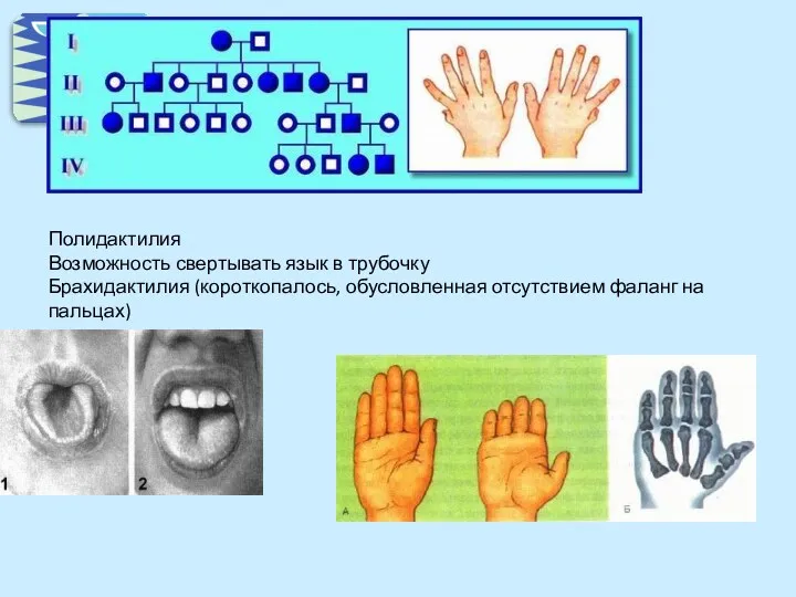 Полидактилия Возможность свертывать язык в трубочку Брахидактилия (короткопалось, обусловленная отсутствием фаланг на пальцах)