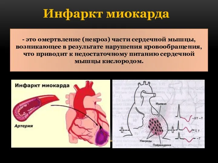 Инфаркт миокарда - это омертвление (некроз) части сердечной мышцы, возникающее в результате нарушения
