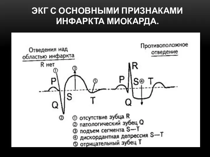 ЭКГ С ОСНОВНЫМИ ПРИЗНАКАМИ ИНФАРКТА МИОКАРДА.