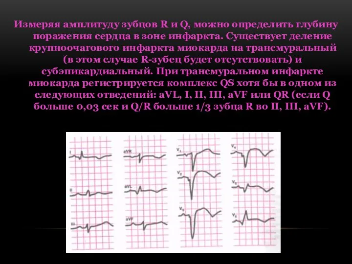 Измеряя амплитуду зубцов R и Q, можно определить глубину поражения сердца в зоне