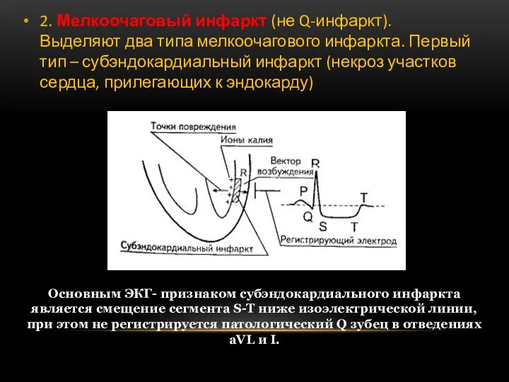 2. Мелкоочаговый инфаркт (не Q-инфаркт). Выделяют два типа мелкоочагового инфаркта.