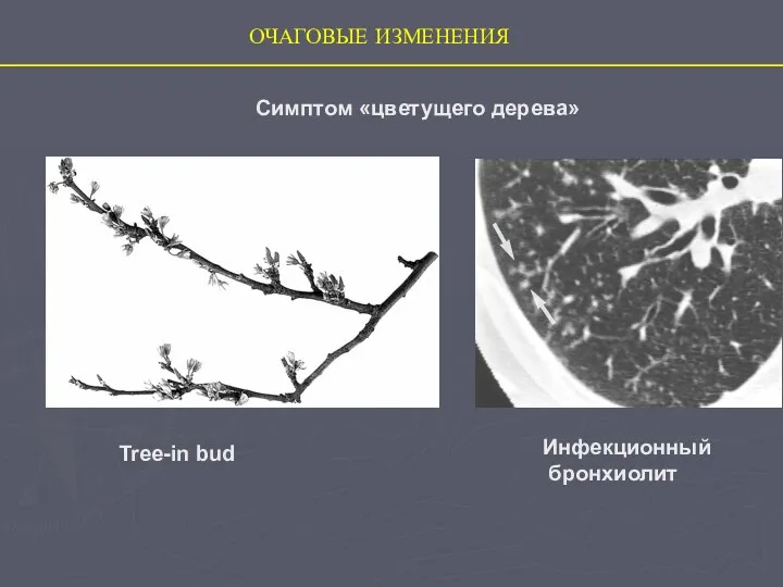 Tree-in bud ОЧАГОВЫЕ ИЗМЕНЕНИЯ Симптом «цветущего дерева» Инфекционный бронхиолит