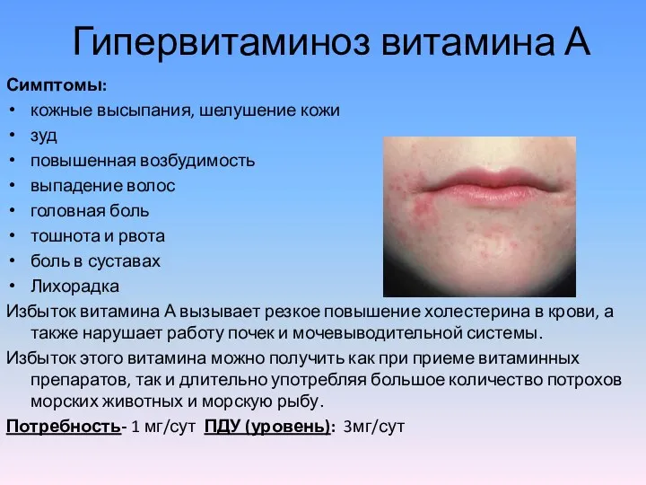 Гипервитаминоз витамина А Симптомы: кожные высыпания, шелушение кожи зуд повышенная