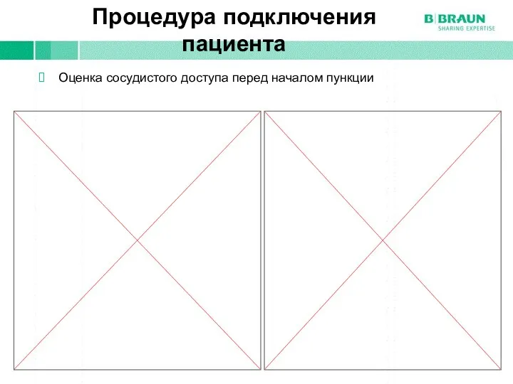 Процедура подключения пациента Оценка сосудистого доступа перед началом пункции