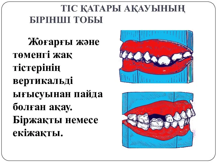 ТІС ҚАТАРЫ АҚАУЫНЫҢ БІРІНШІ ТОБЫ Жоғарғы және төменгі жақ тістерінің вертикальді ығысуынан пайда