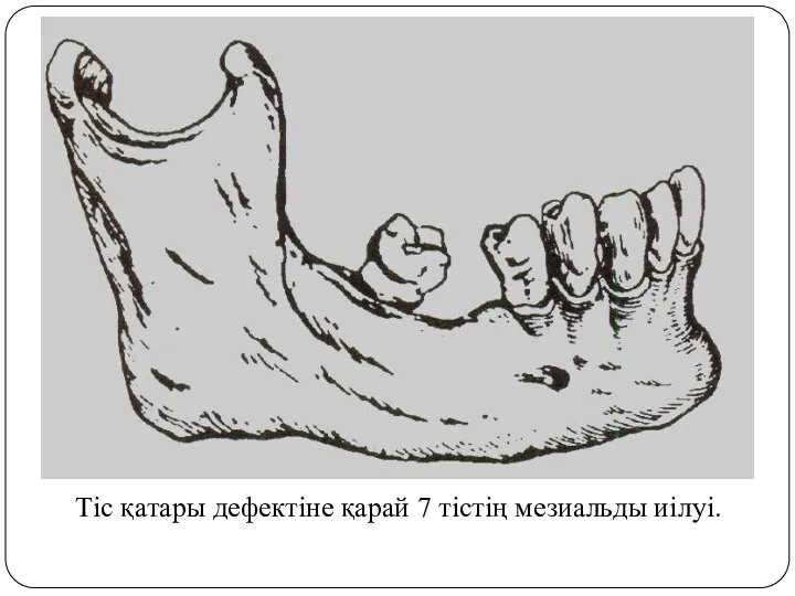 Тіс қатары дефектіне қарай 7 тістің мезиальды иілуі.