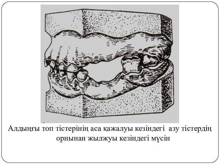 Алдыңғы топ тістерінің аса қажалуы кезіндегі азу тістердің орнынан жылжуы кезіндегі мүсін