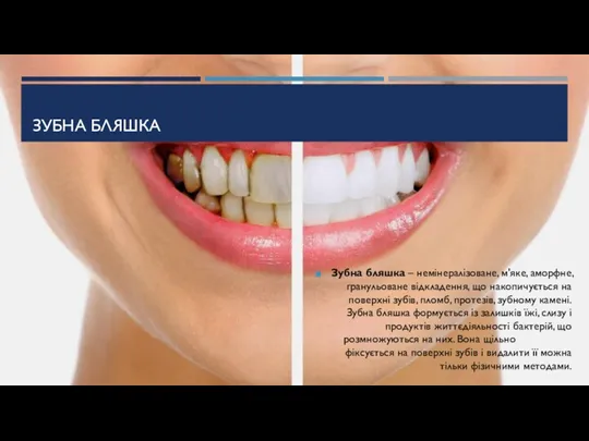 ЗУБНА БЛЯШКА Зубна бляшка – немінералізоване, м'яке, аморфне, гранульоване відкладення,