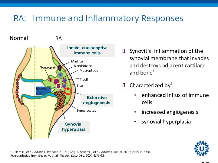 RA: Immune and Inflammatory Responses Synovitis: inflammation of the synovial membrane that invades
