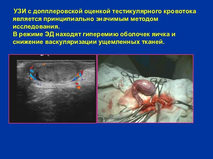 УЗИ с допплеровской оценкой тестикулярного кровотока является принципиально значимым методом