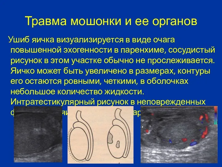 Травма мошонки и ее органов Ушиб яичка визуализируется в виде