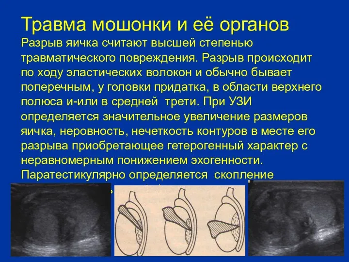 Травма мошонки и её органов Разрыв яичка считают высшей степенью