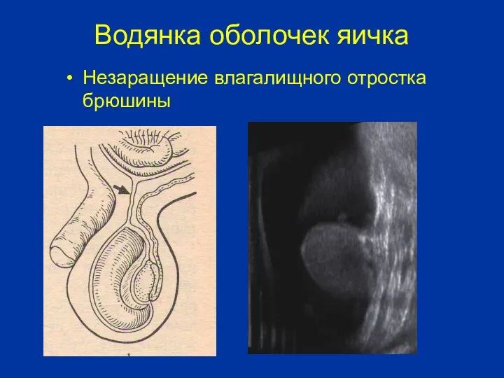 Водянка оболочек яичка Незаращение влагалищного отростка брюшины