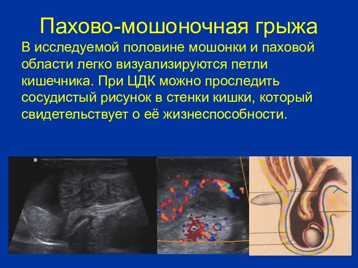 Пахово-мошоночная грыжа В исследуемой половине мошонки и паховой области легко