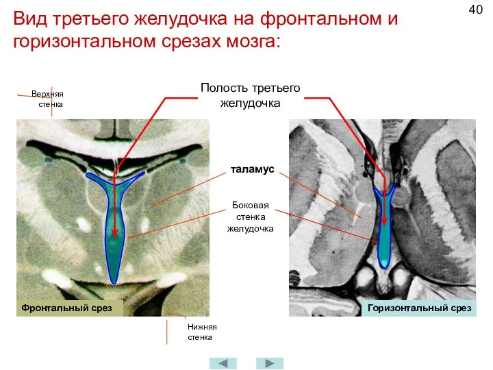 Вид третьего желудочка на фронтальном и горизонтальном срезах мозга: Полость
