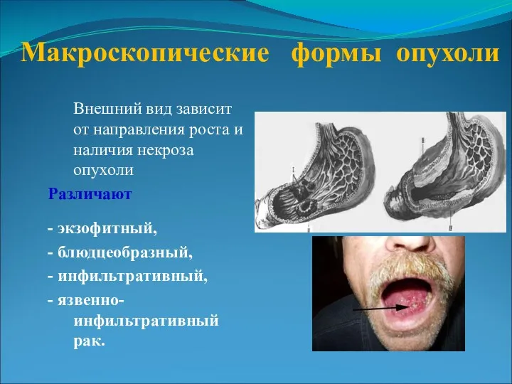 Макроскопические формы опухоли Внешний вид зависит от направления роста и