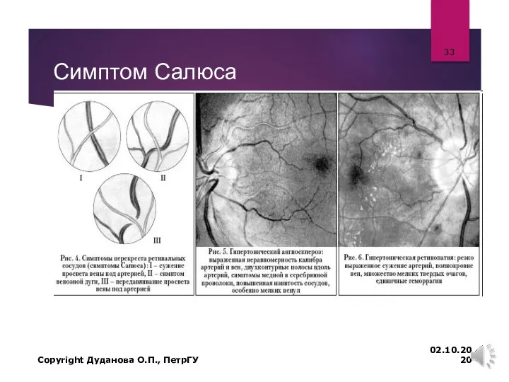 Симптом Салюса 02.10.2020 Copyright Дуданова О.П., ПетрГУ