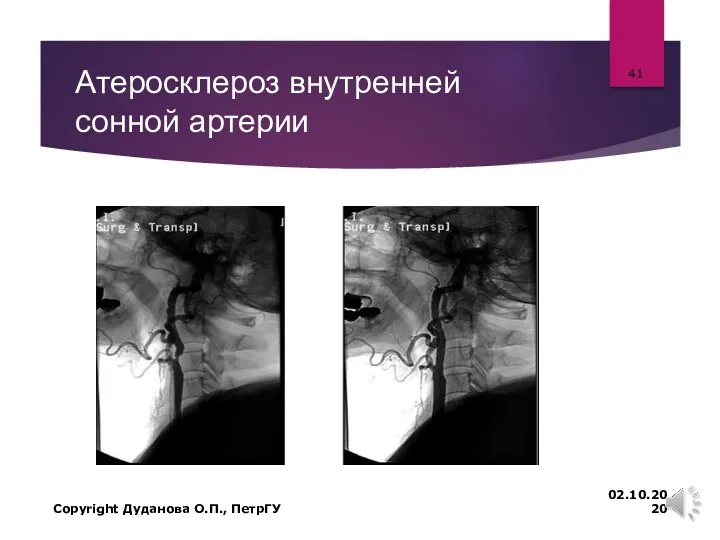 Атеросклероз внутренней сонной артерии 02.10.2020 Copyright Дуданова О.П., ПетрГУ